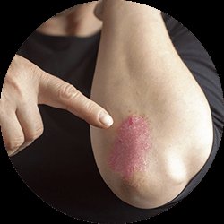 bug bites that rash,Understanding the Itching: Bug Bites That Rash