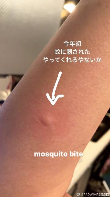 mosquito bite remedies,Understanding the Itch: The Dilemma of a Mosquito Bite