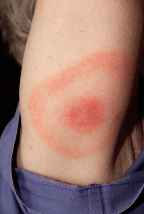 spider bite rash,Spider Bite Rash: A Comprehensive Guide